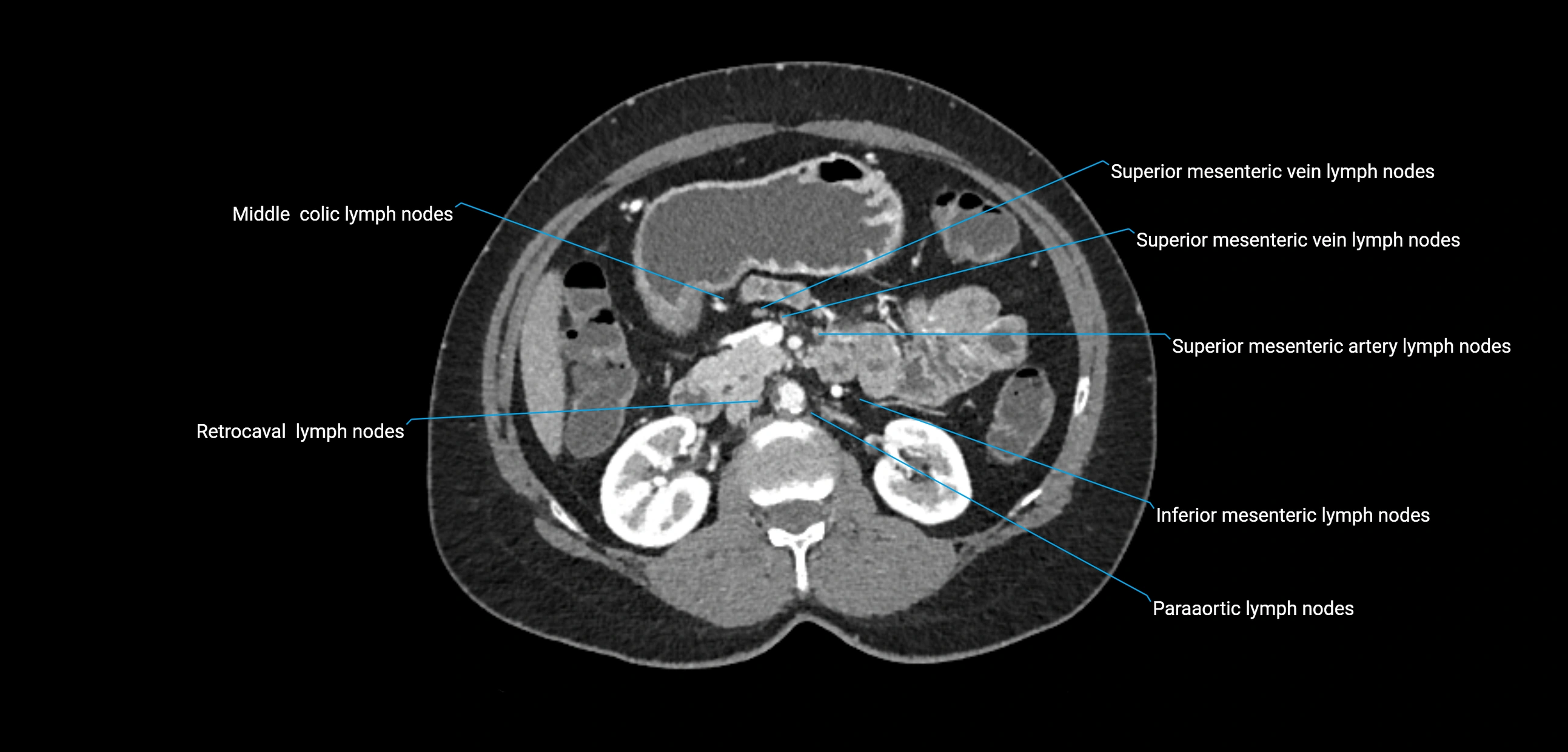 CT ct abdominal lymph nodes  axial cross sectional anatomy  enchanced radiology image -img-00002-00186.webp